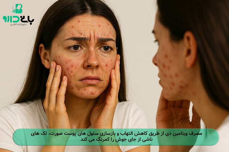 بررسی ارتباط بین ویتامین دی و لک صورت